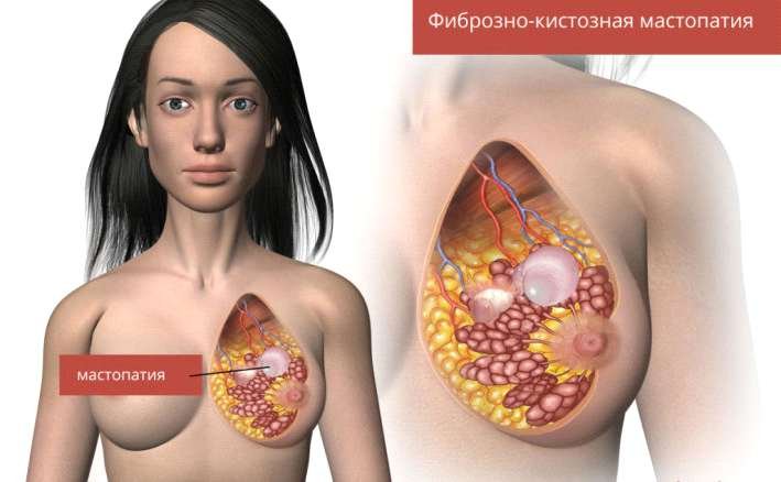 Лечение фиброзная кистозной мастопатия