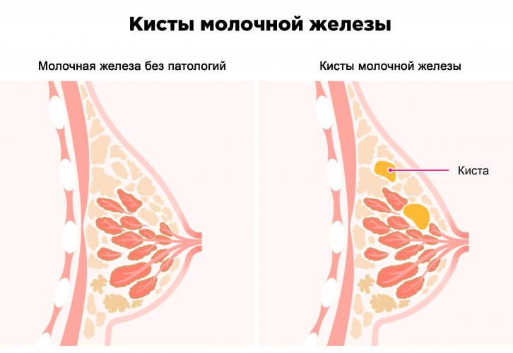 Операция по удалению кисты молочной железы в Одессе