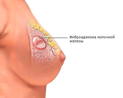 Лечение аденомы молочной железы