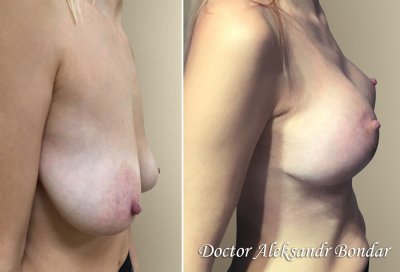 Цена на операцию по уменьшению груди