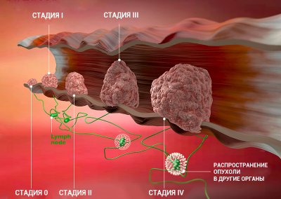 Развитие рака груди с  0 стадии до 4
