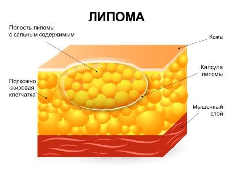 Лечение липомы молочной железы в Одессе