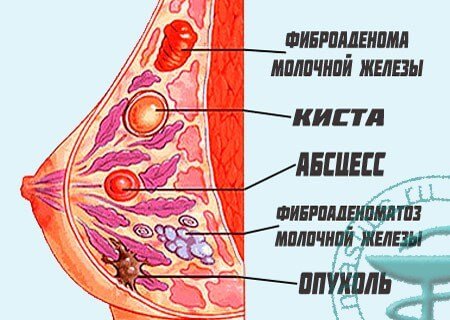  Диагностика фиброаденомы молочной железы в Одессе