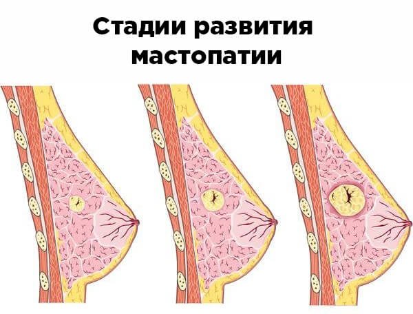 Стадии развития мастопатии