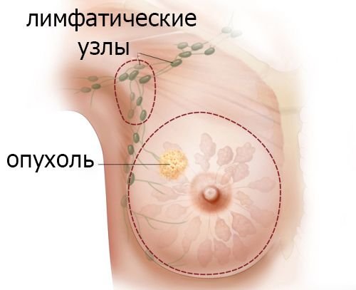 Удаление филоидной опухоли молочной железы