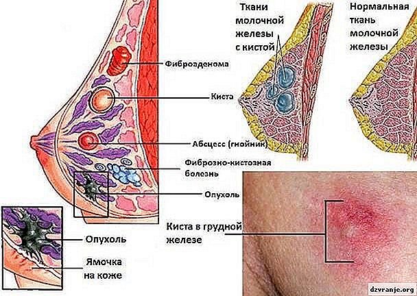Как выглядит киста молочной железы?