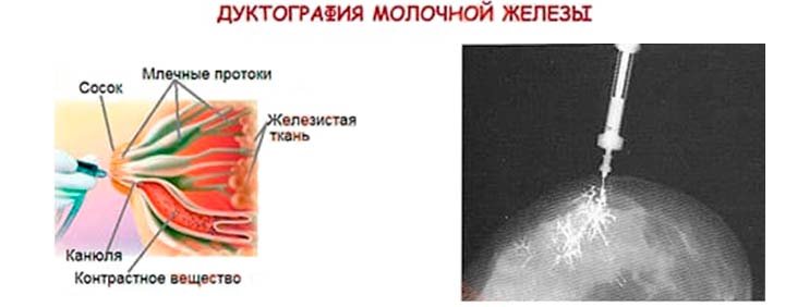 Проведение дуктографии молочной железы в Одессе
