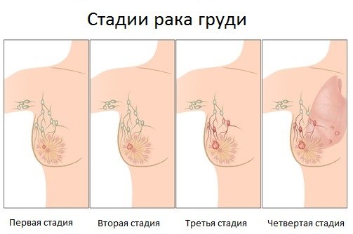 Как выглядит рак груди на разных стадиях