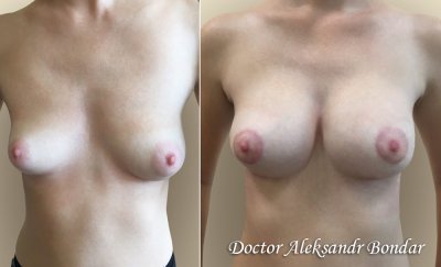 операция по увеличению груди в Одессе